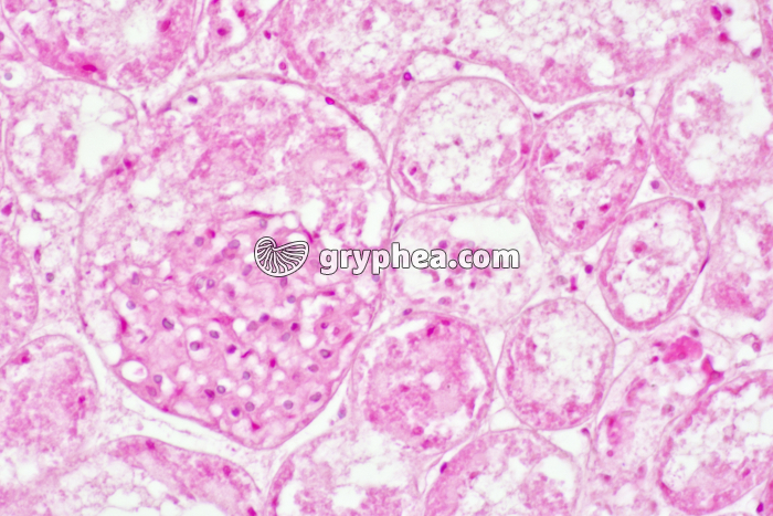 Rejet de greffe de rein x160 - gryphea.org